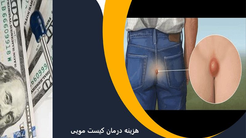 بیماری کیست مویی و هزینه های درمان بیماری کیست مویی و هزینه های درمان