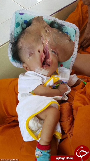 کودکی که استخوان جمجمه ندارد (+عکس)