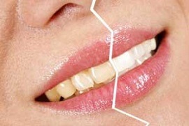 نسخه‌ای معجزه ‌آسا برای سفید کردن دندان