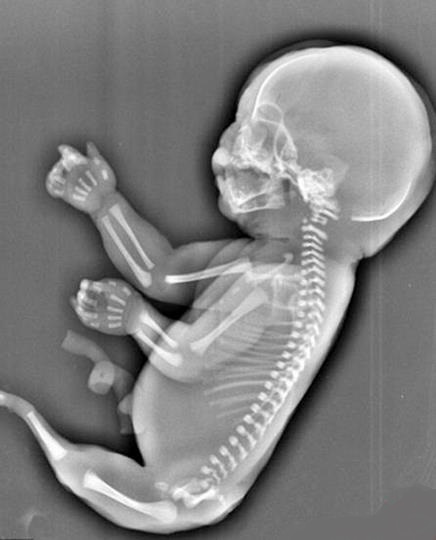 به دنیا آمدن نوزادی همانند پری دریایی(+عکس)