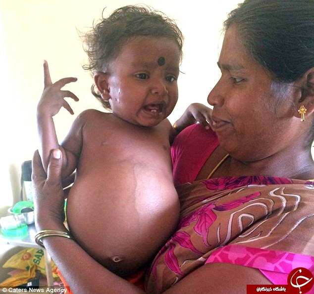 نوزاد دختر هنگام تولد، دوقلو باردار بود(+عکس)