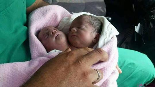 تولد نوزاد دو سر در سوریه (+عکس)