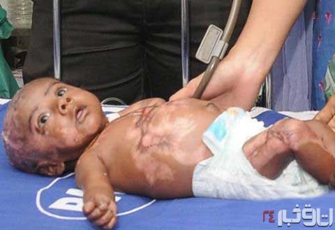 بدن این کودک بدون هیچ دلیلی خودسوزی می کند(+عکس)