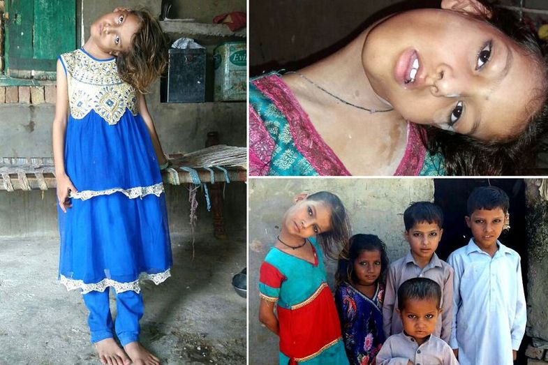بیماری عجیب یک دختر پاکستانی (+ عکس)