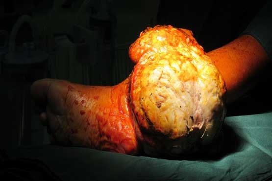 خروج تومور 2 کیلویی از پای یک بیمار (+عکس)