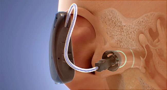 سمعک (hearing aids) چیست؟ راهنمای خرید بهترین سمعک