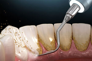 روش‌های آسان برای از بین بردن جرم دندان