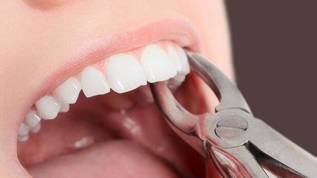 چند نکته مهم پس از کشیدن دندان عقل