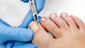 روش درمان درد فرو رفتن ناخن در گوشت پا