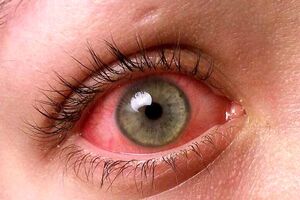 روش های درمان قرمزی چشم