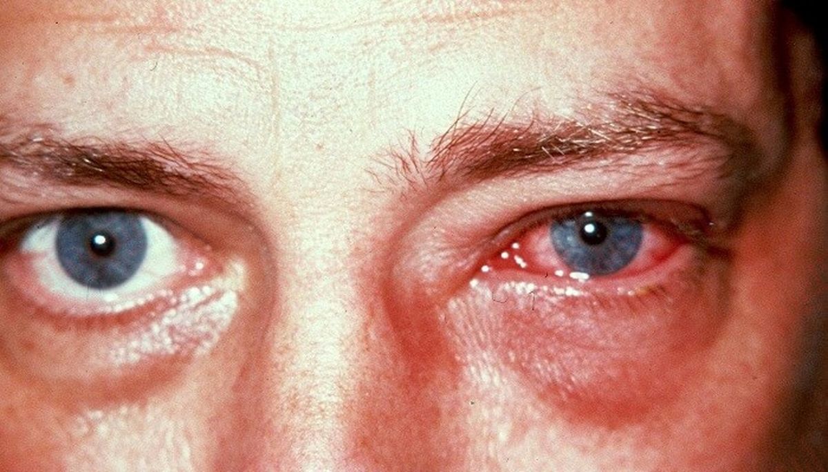 هشت عفونت شایع چشم و نحوه درمان آن‌ها