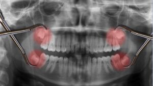 رمزگشایی از ماهیت دندان عقل