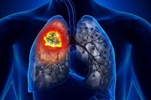 روغنی که می‌تواند تومورهای سرطان ریه را کوچک کند