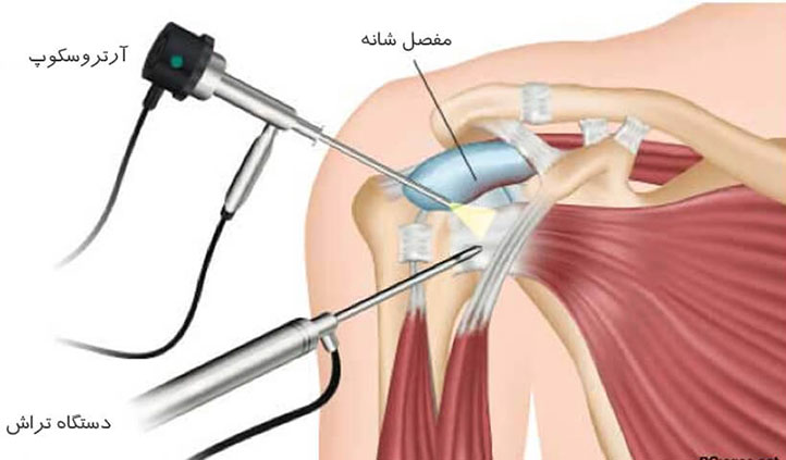 بهترین جراح آرتروسکوپی شانه در تهران