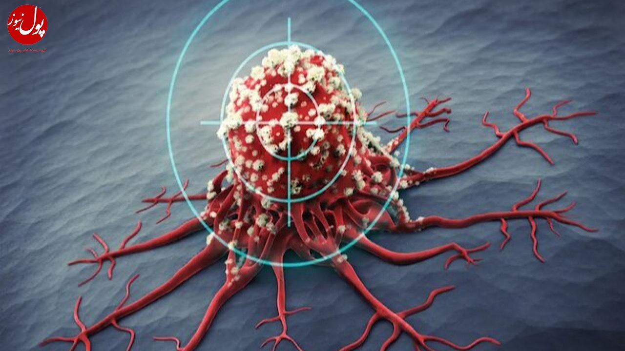 معرفی روش جدیدی برای تشخیص زودهنگام سرطان تخمدان